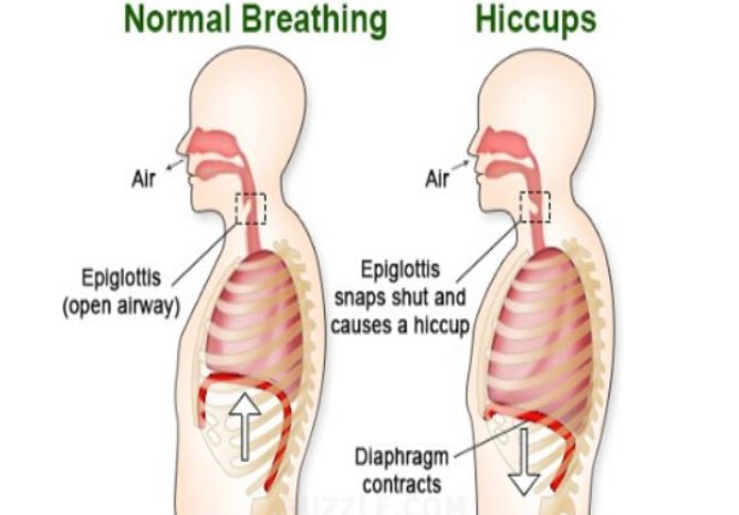 hiccups how diagram