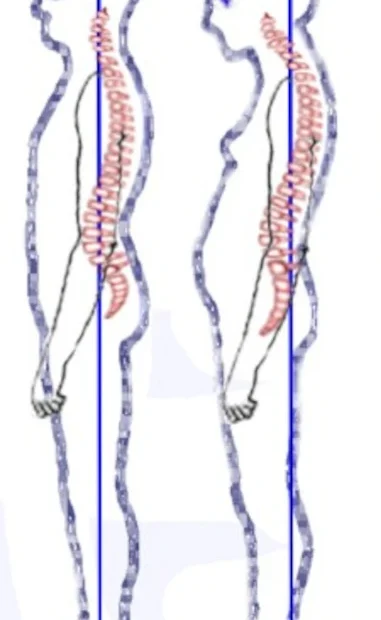 Hyper Kyphosis Posture