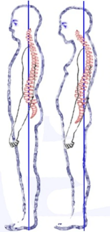 Hyper Kyphosis Posture
