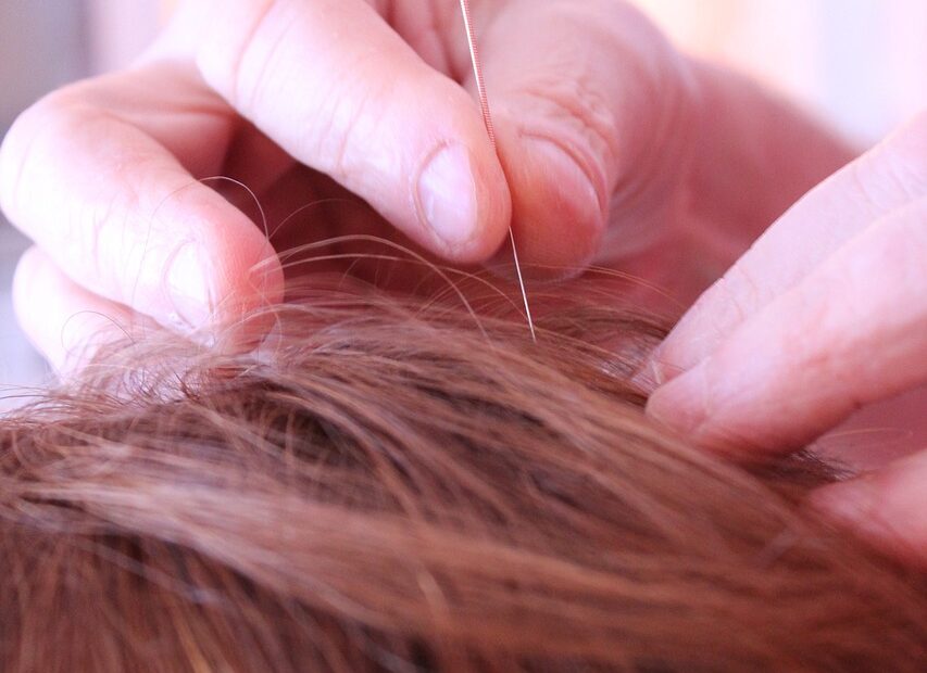 acupuncture for cancer patients - scalp
