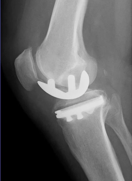 picture of x-ray after knee surgery