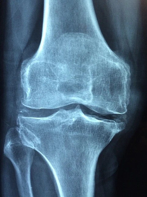 can acupuncture prevent knee surgery? An x-ray of the back of the knee