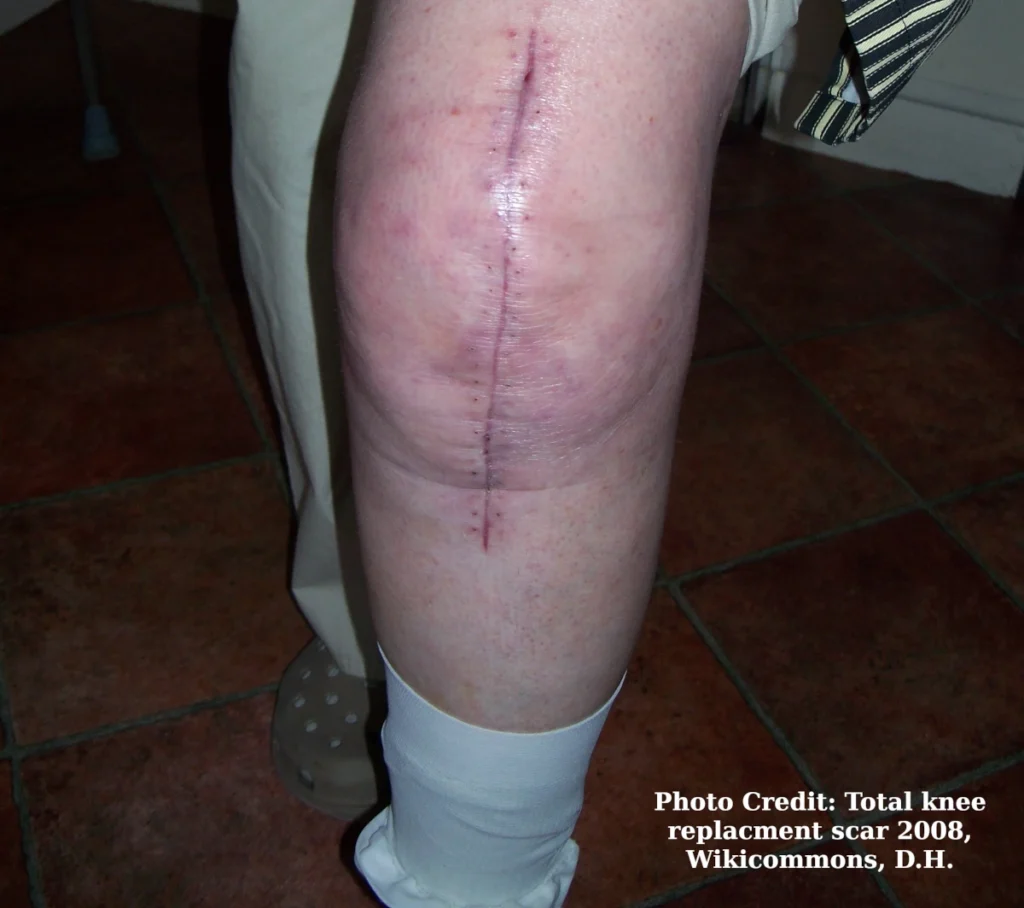 total knee replacement scar