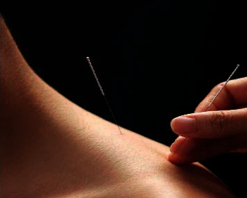 acupuncture after neck surgery