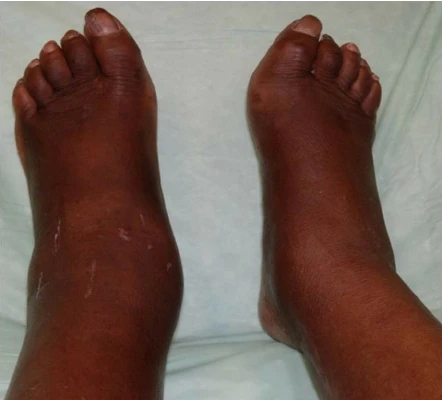 Example of Edema