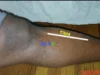 Spleen 9 Acupuncture Point Location, Practical Uses, and Benefits