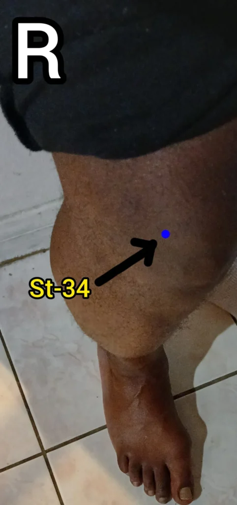 stomach 34 (st-34) acupuncture point location