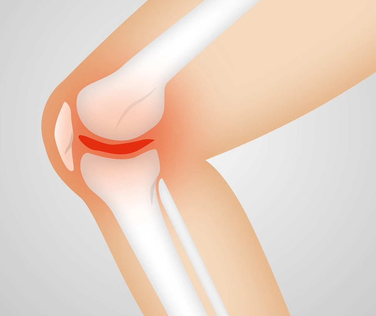 Acupuncture For Swollen Knee