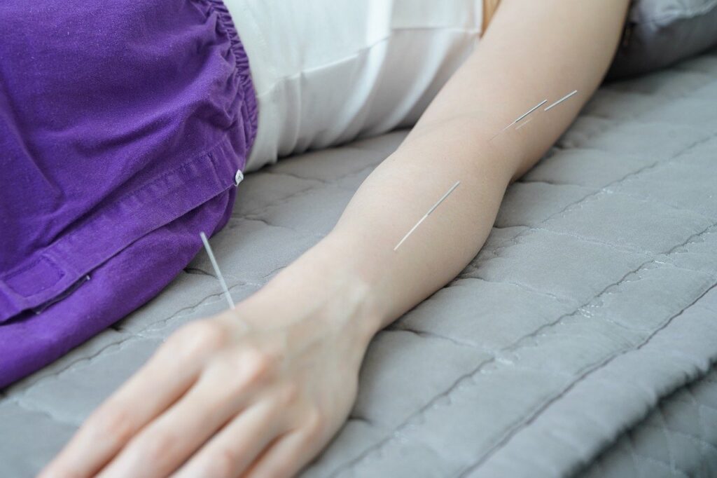 acupuncture on the arm for pain mangement